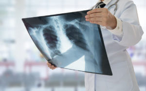 Doctor looking at an X-ray of lungs to determine the efficacy of lung cancer treatment.